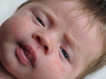 Dermatitis im Baby: die Ursachen und die Art der Behandlung