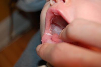 weiße Beschichtung auf der Zunge des Babys