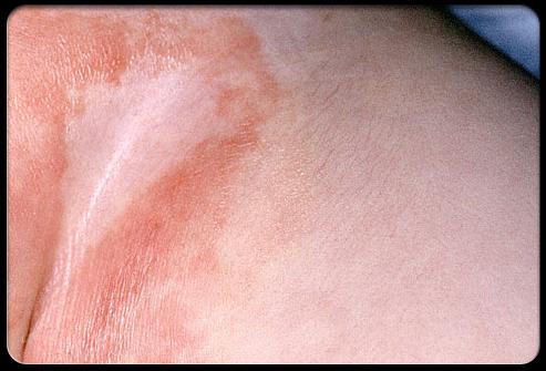 Hautausschläge bei Erwachsenen und Kindern